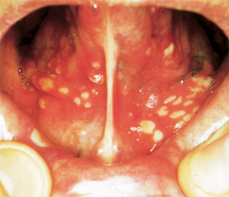 heptic ulcer